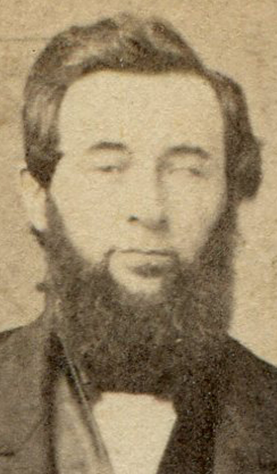 ONE EYED MAN WITH THICK BEARD. CDV. EASTON, PA.