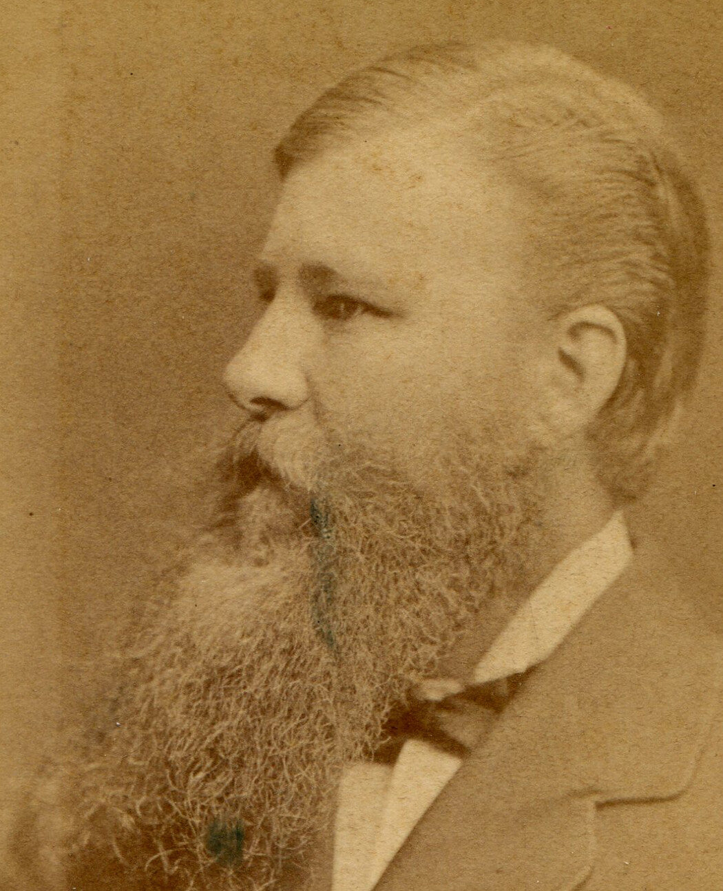 FLESHY FACED MAN WITH IMPRESSIVE BEARD. CDV. STOCKHOLM, SWEDEN.