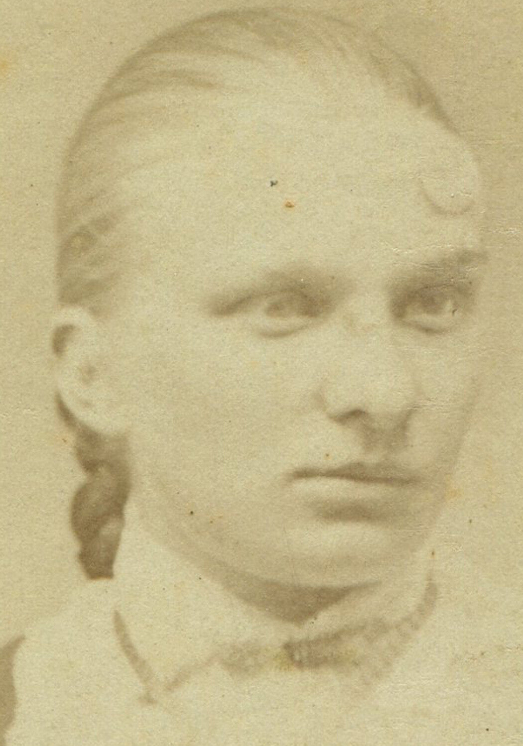 YOUNG WOMAN WITH SCAR/HORN ON FOREHEAD. CDV. QUAKERTOWN, PA.