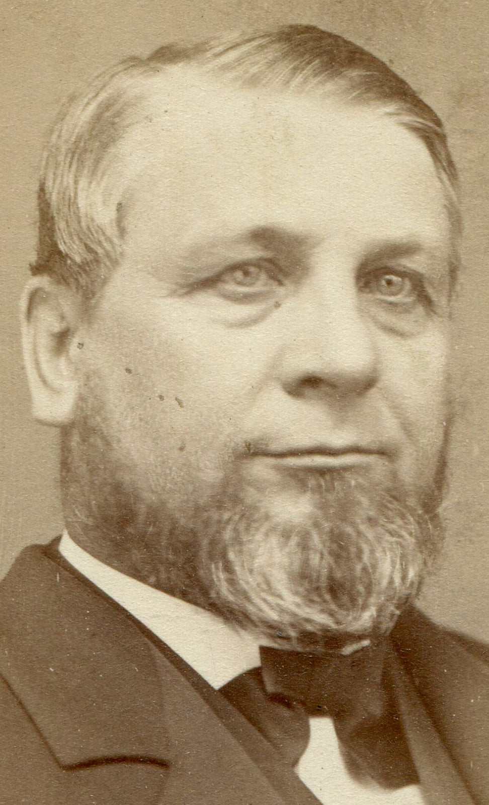 MAN WITH BAGS UNDER EYES. CDV. SPRINGFIELD, MASS.