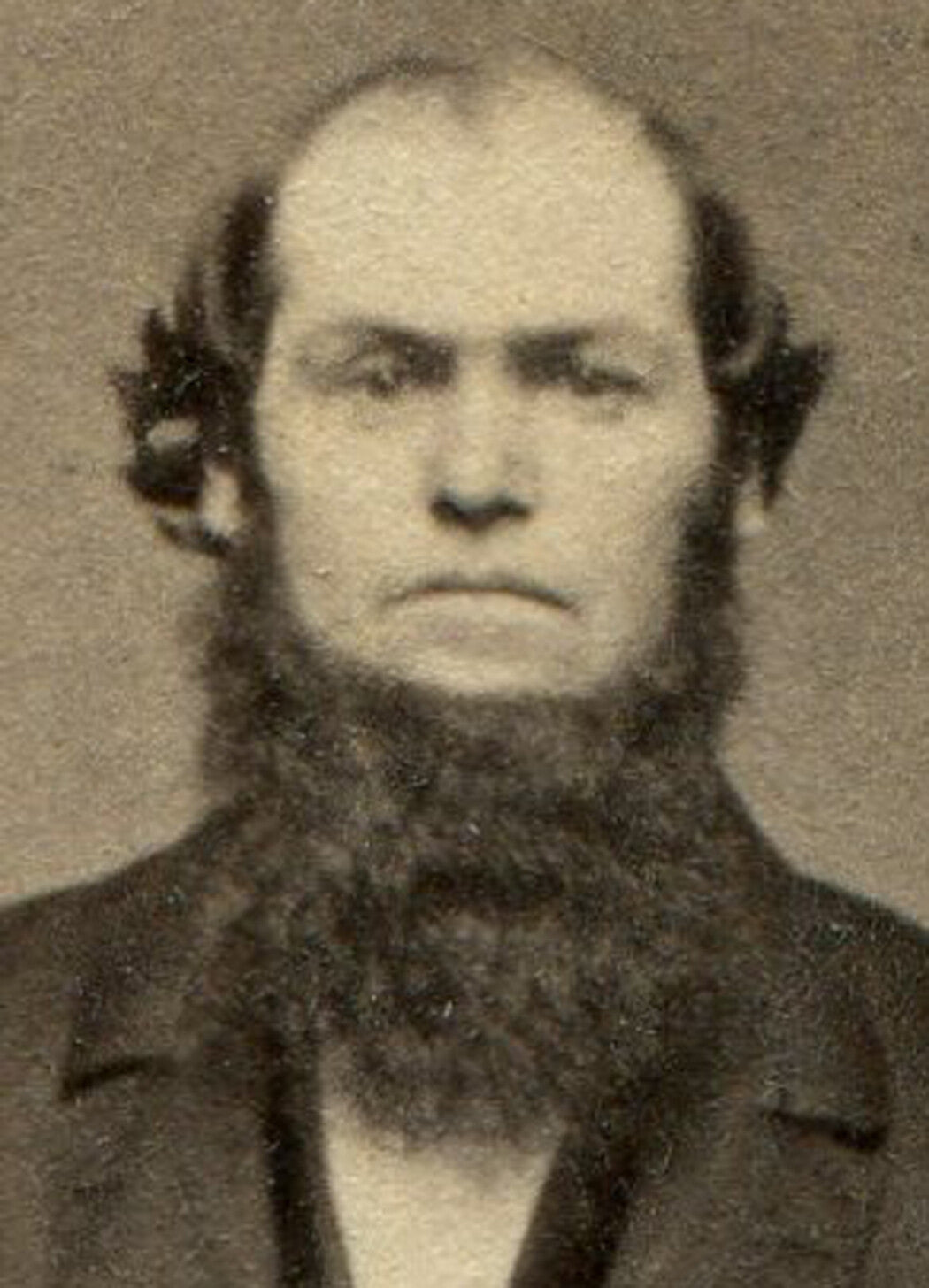 THICKLY BEARDED MAN IN WAIST COAT. CDV. SPRINGFIELD, MASS.