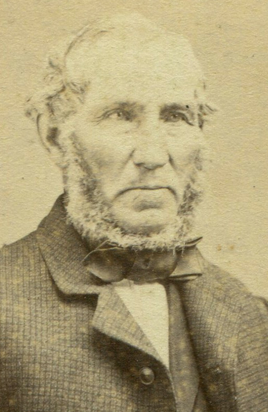 THICK HANDED MAN W/CHIN BEARD. CDV. ST. JOHN, NEW BRUNSWICK, CANADA.